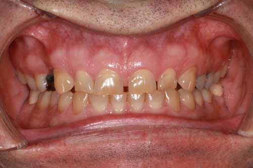 Smile with bruxism wear. Teeth grinding