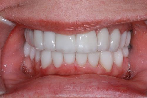 After Dental Implants