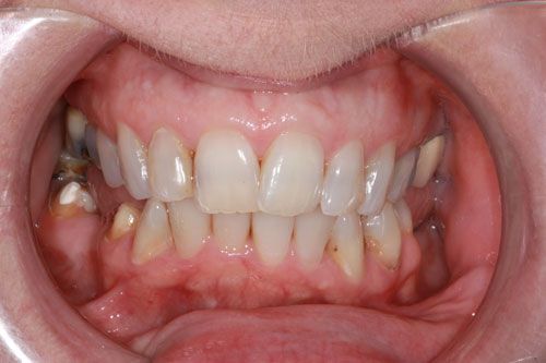 Before dental implants