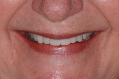 After dental bridges