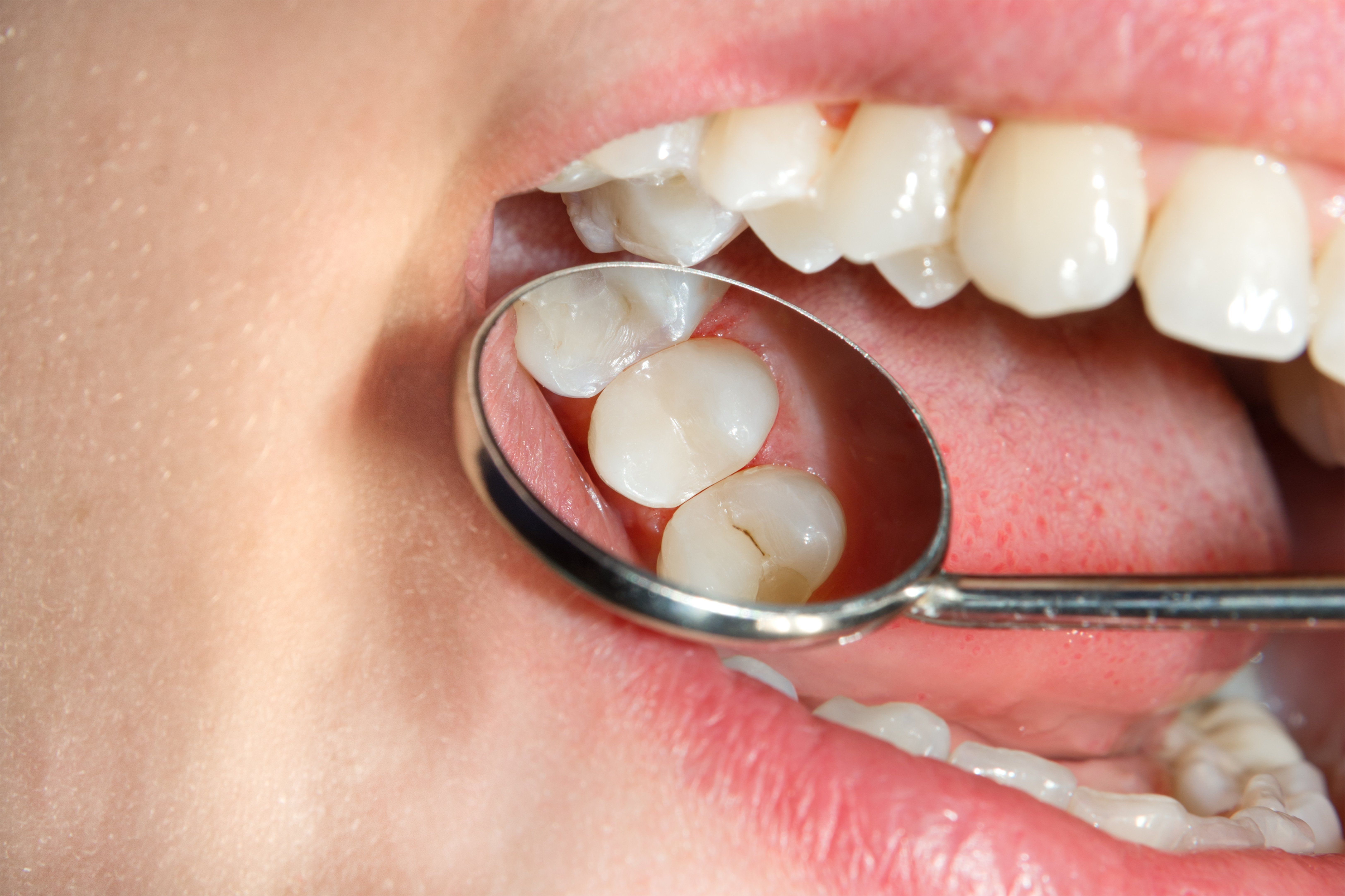 What Are Dental Sealants?