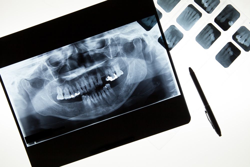 How Often Do I Need Dental X-rays?