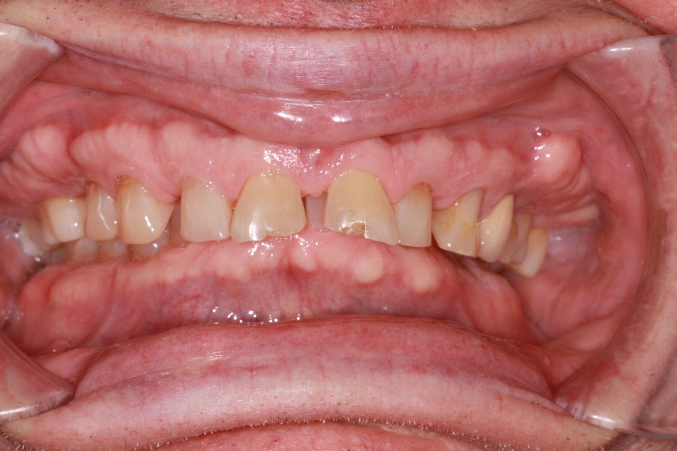 Before smile rehabilitation