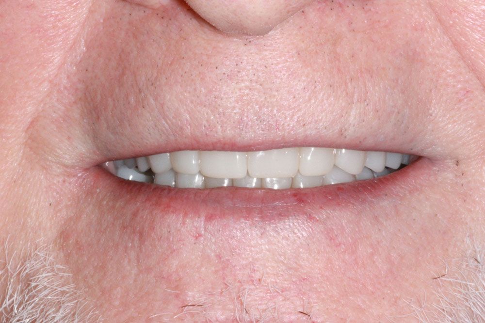 After Dental Implants