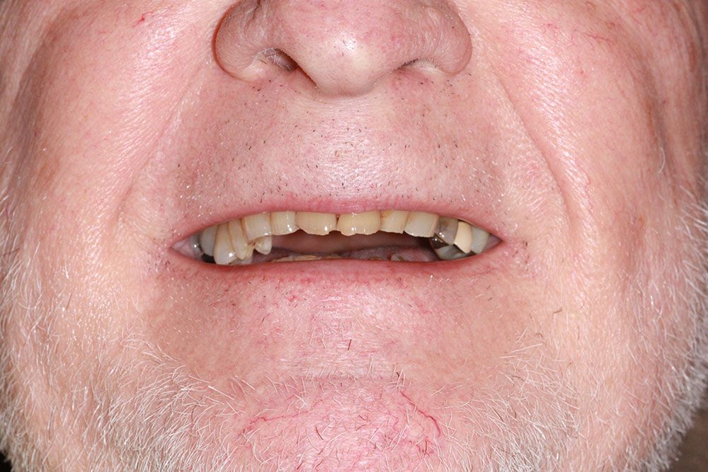 Before dental implants