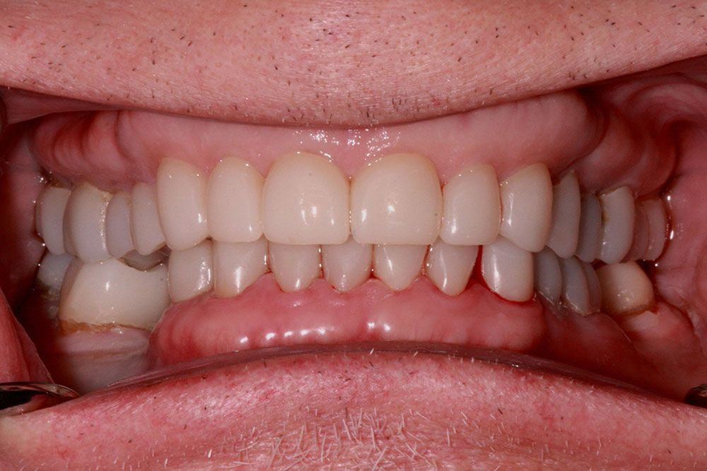 After smile rehabilitation