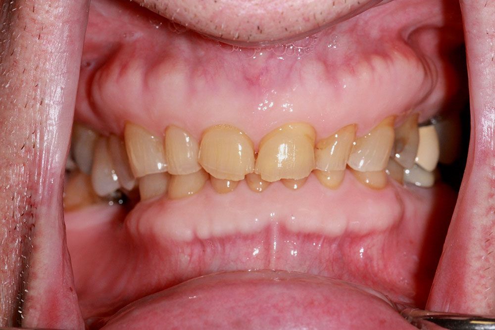 Before smile rehabilitation