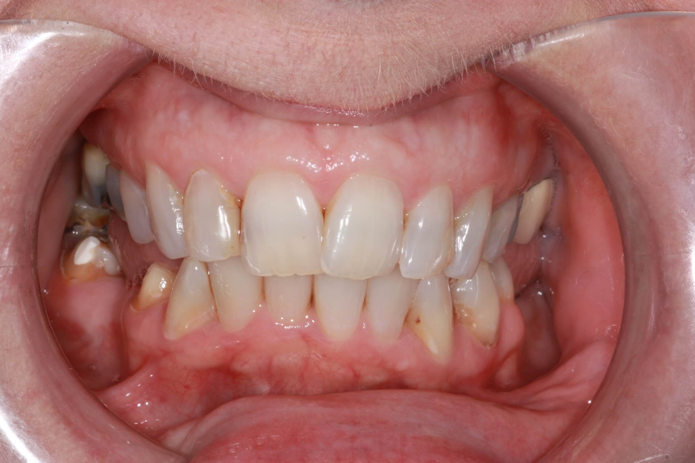 smile makeover before