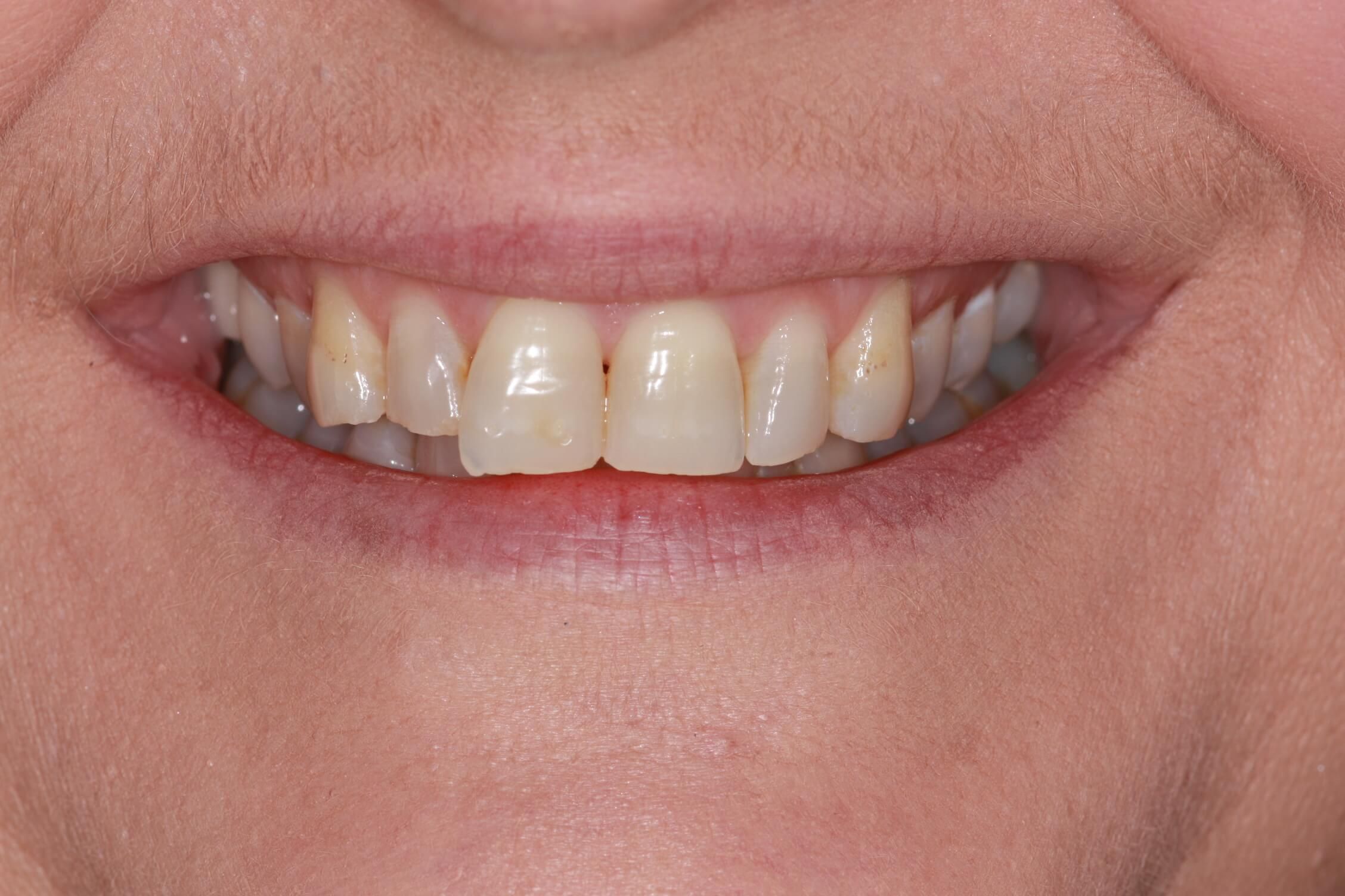 smile makeover before