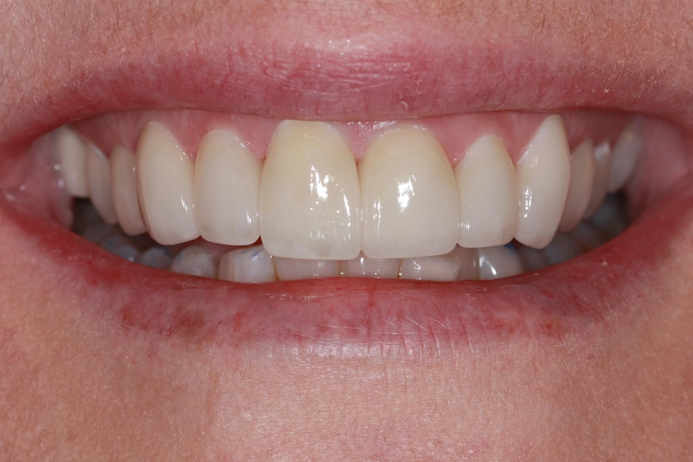 smile makeover after