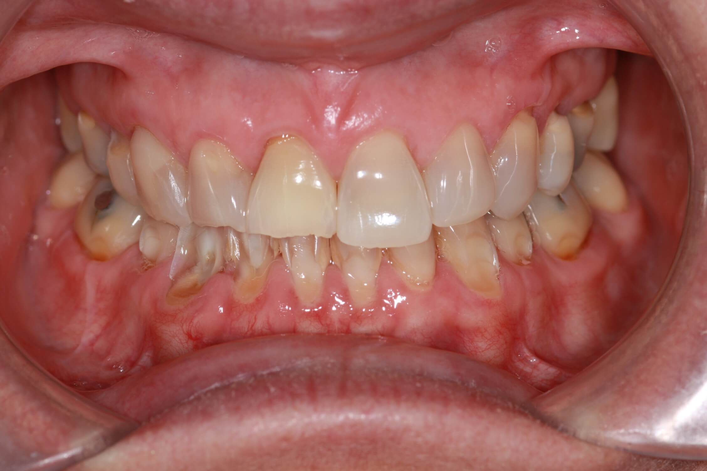 smile makeover before