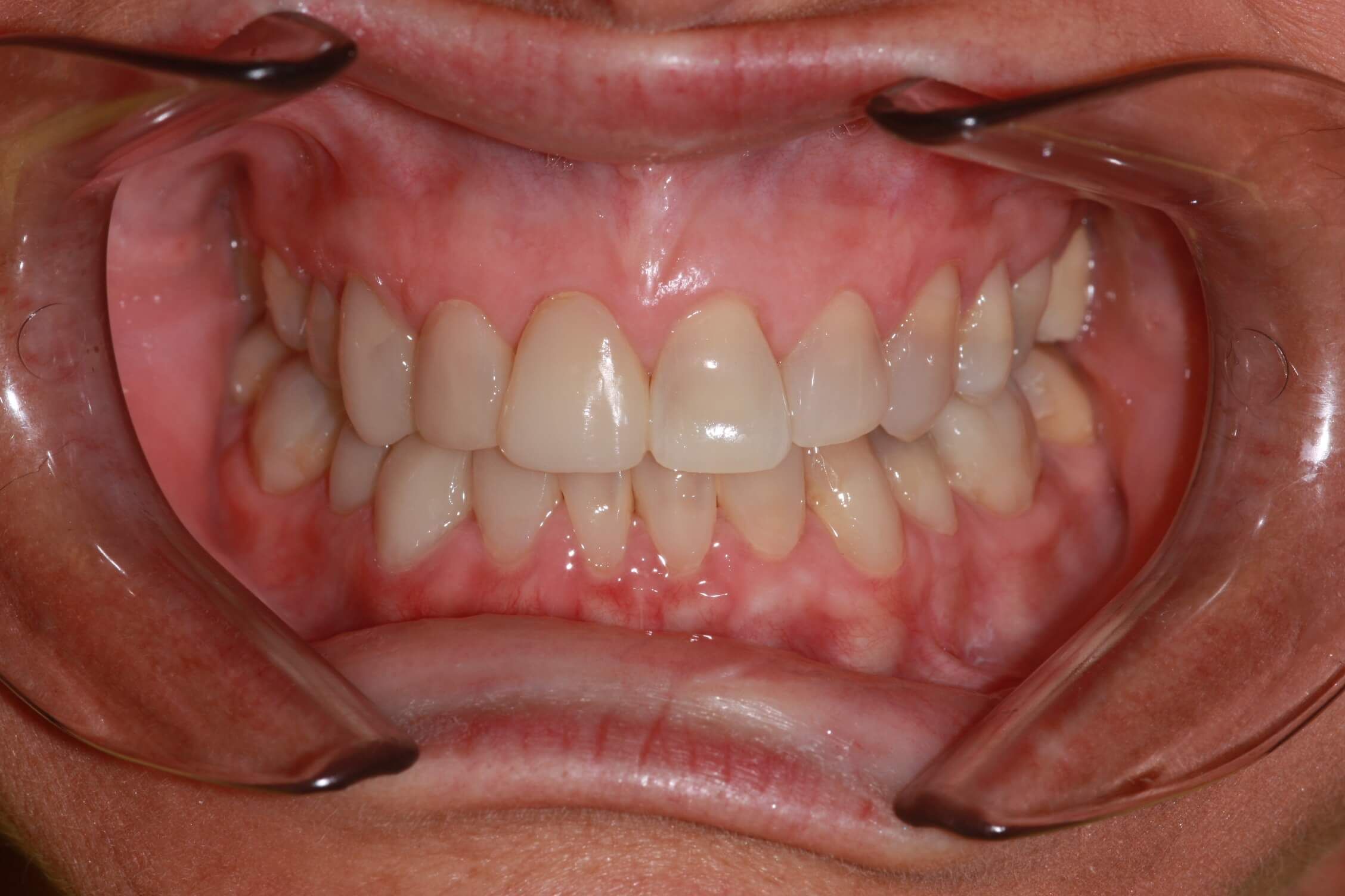 smile makeover after