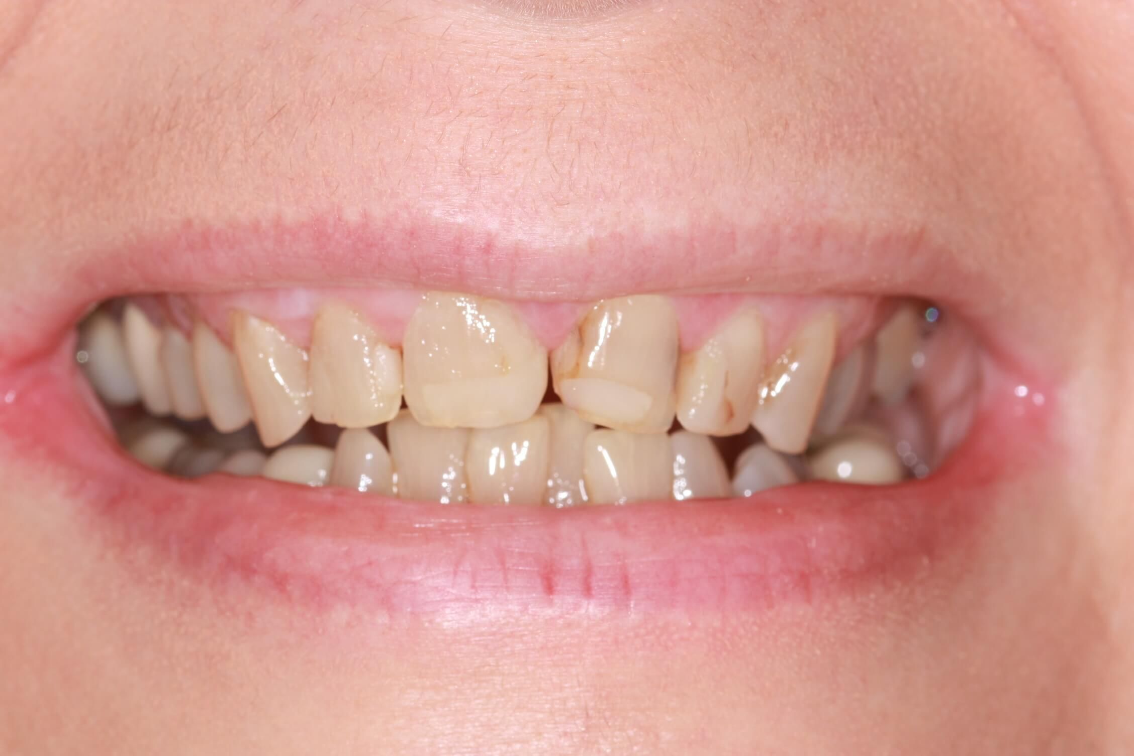 smile makeover before