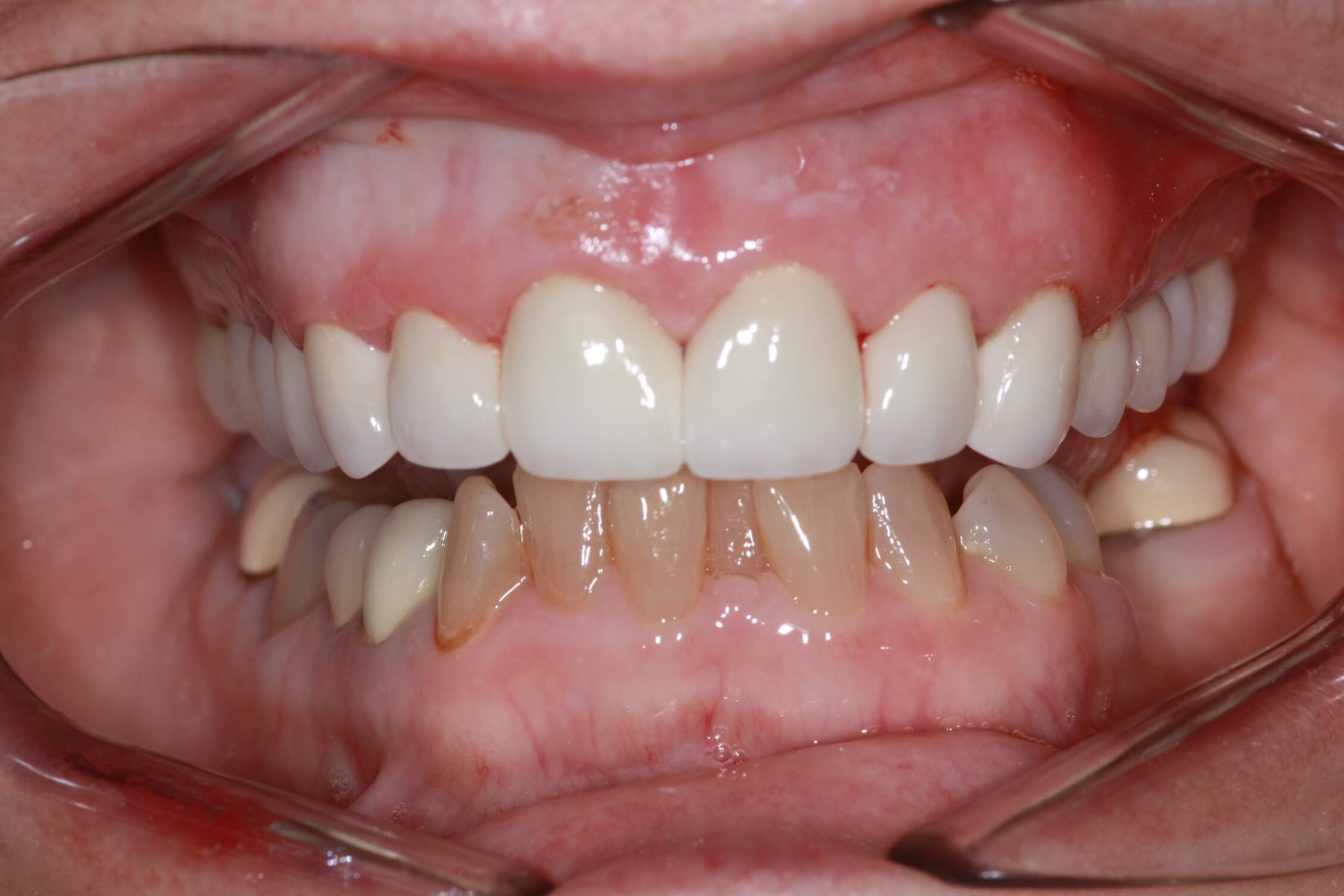 smile makeover after
