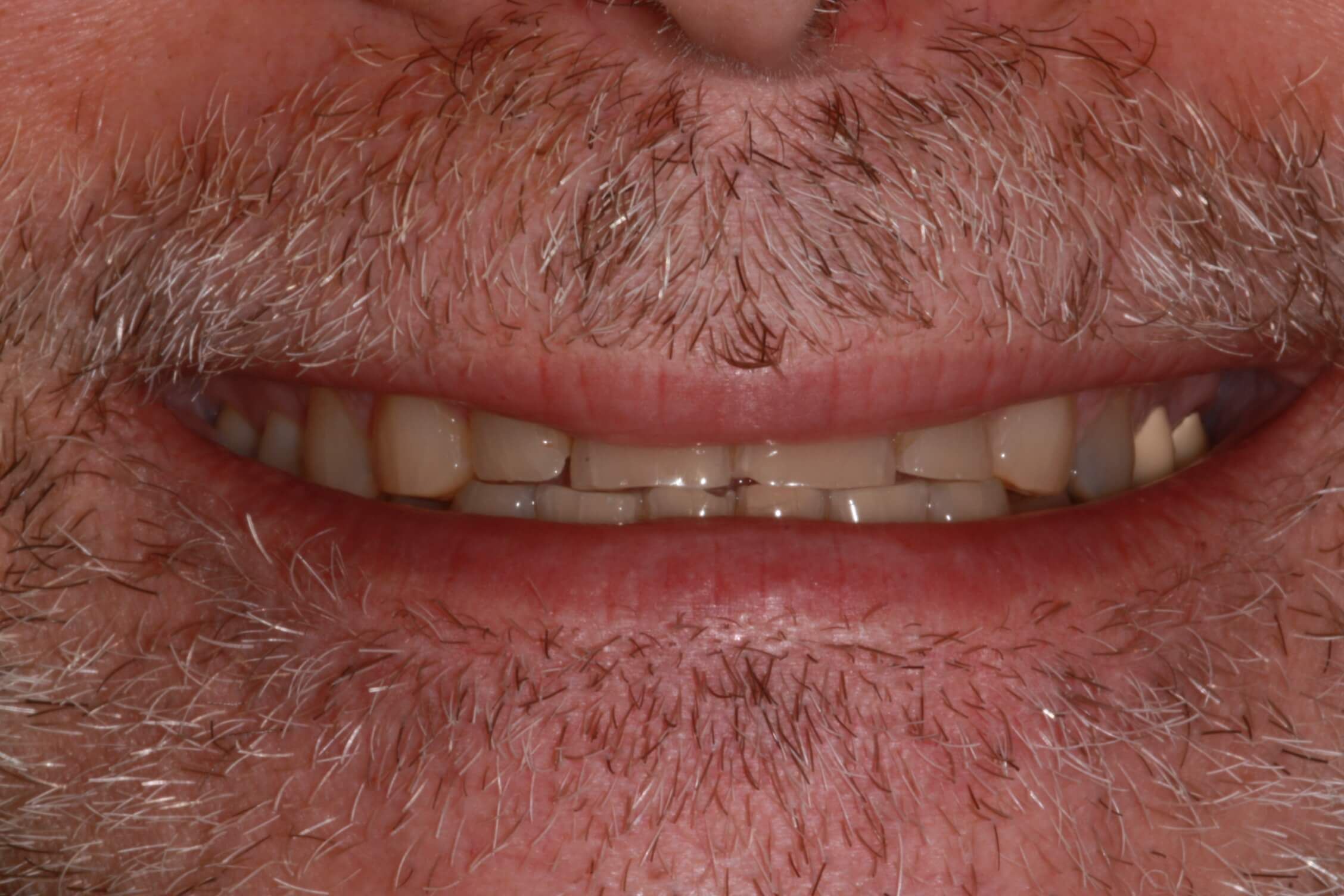 smile makeover before