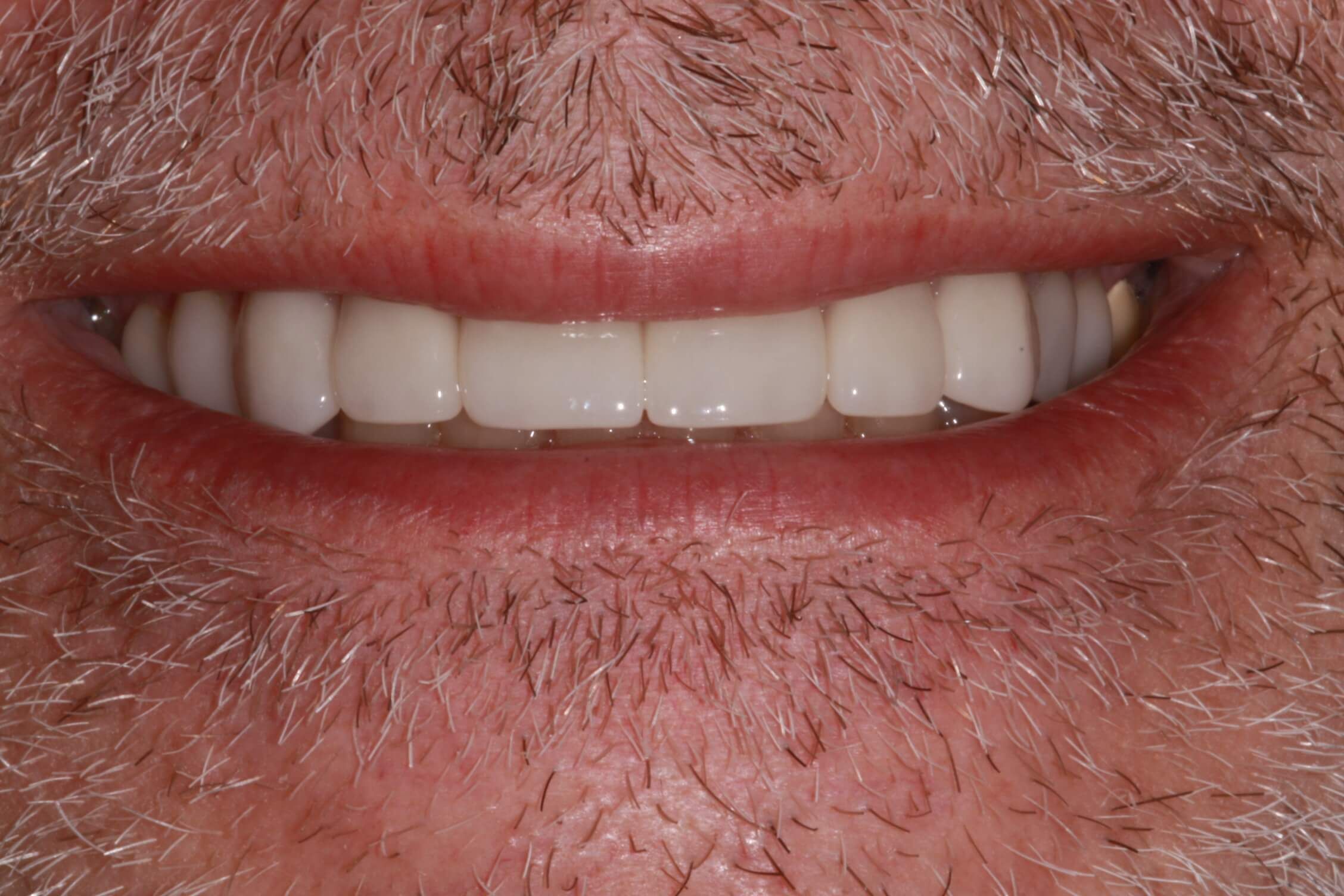 smile makeover after