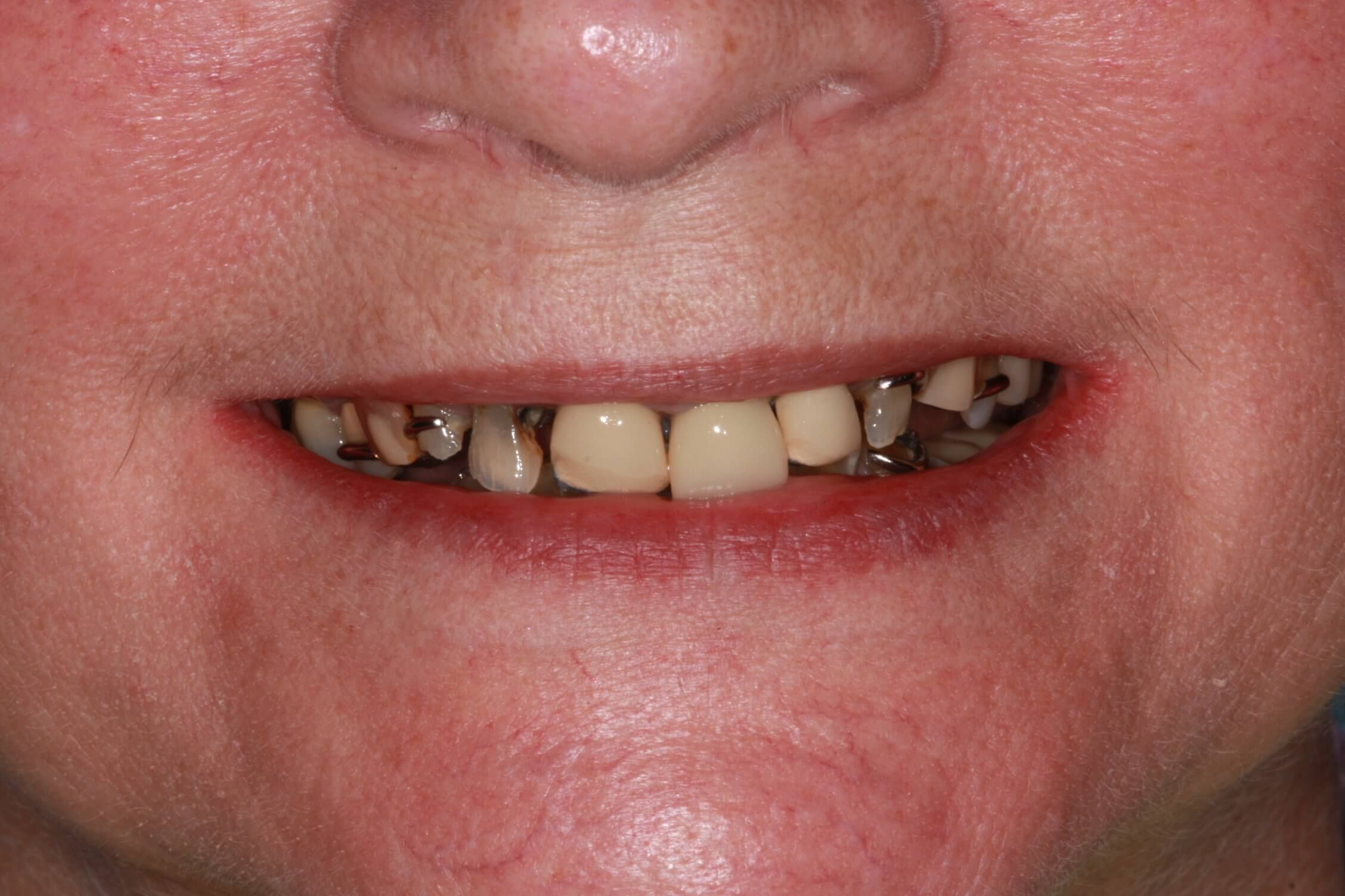 smile makeover before