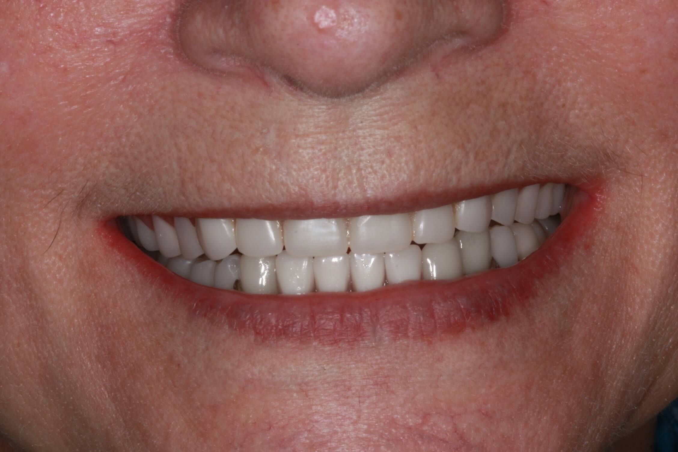 smile makeover after