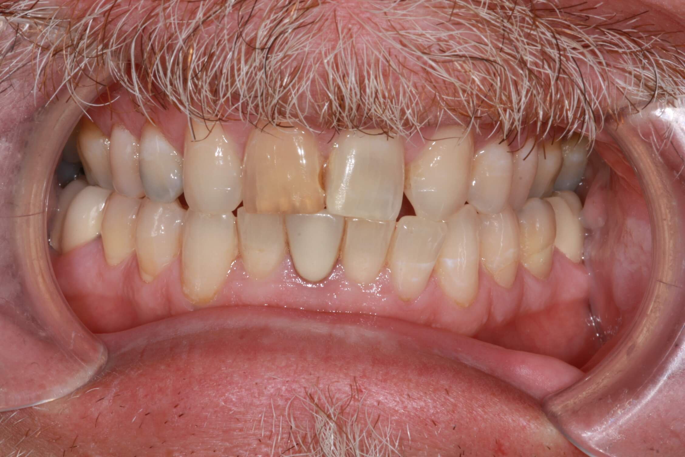 smile makeover before