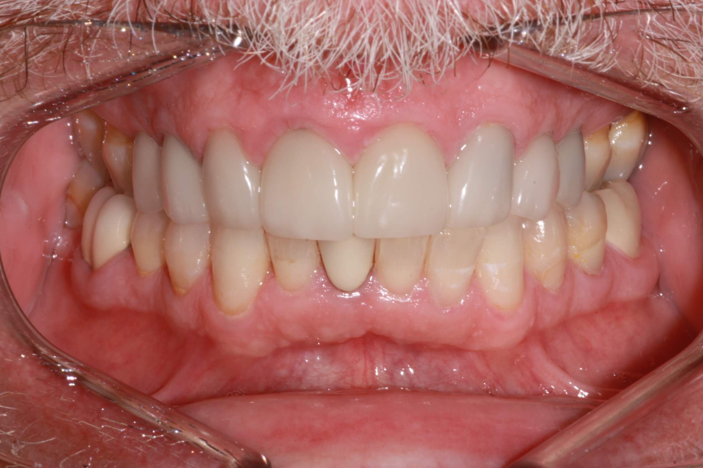 smile makeover after