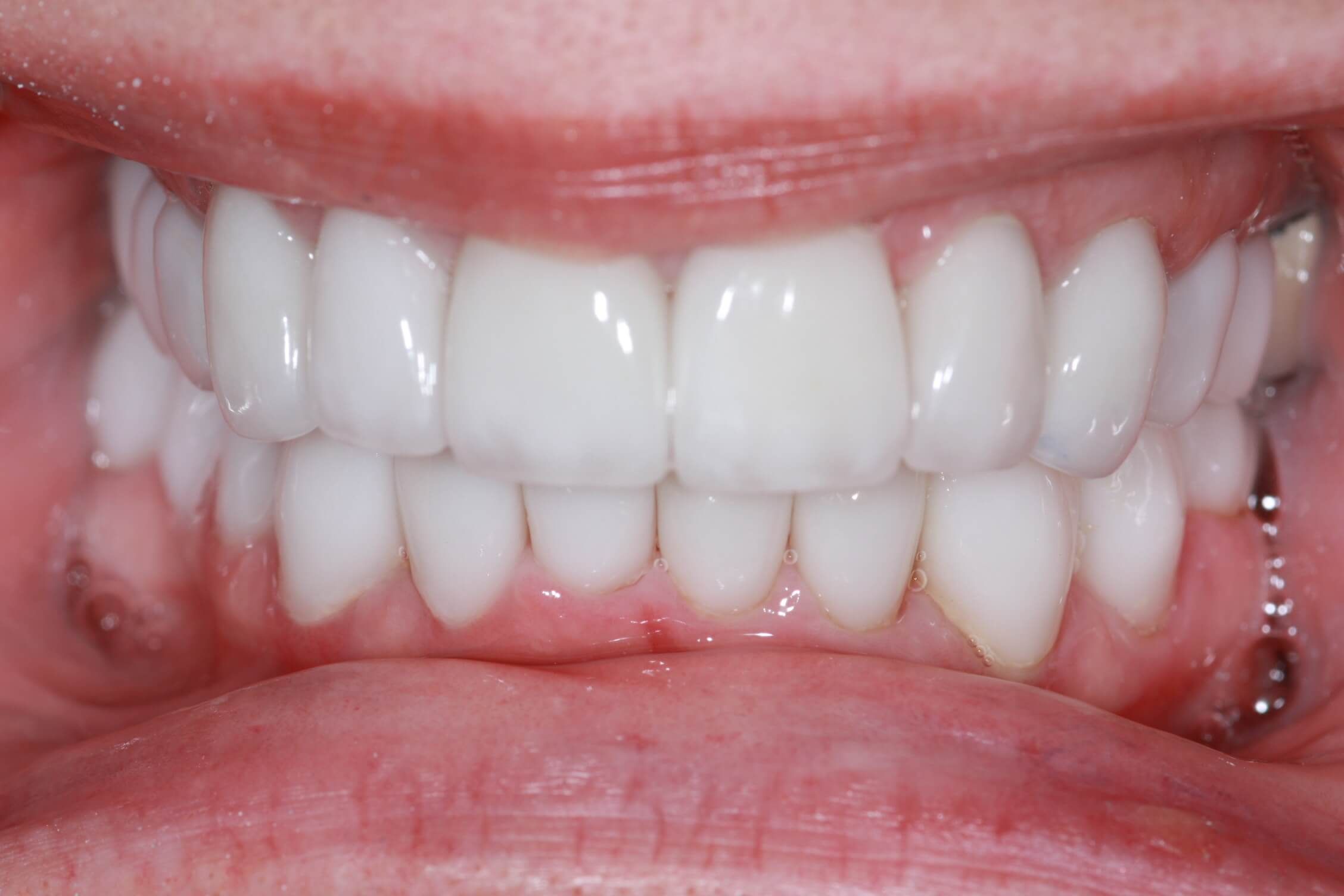 smile makeover after