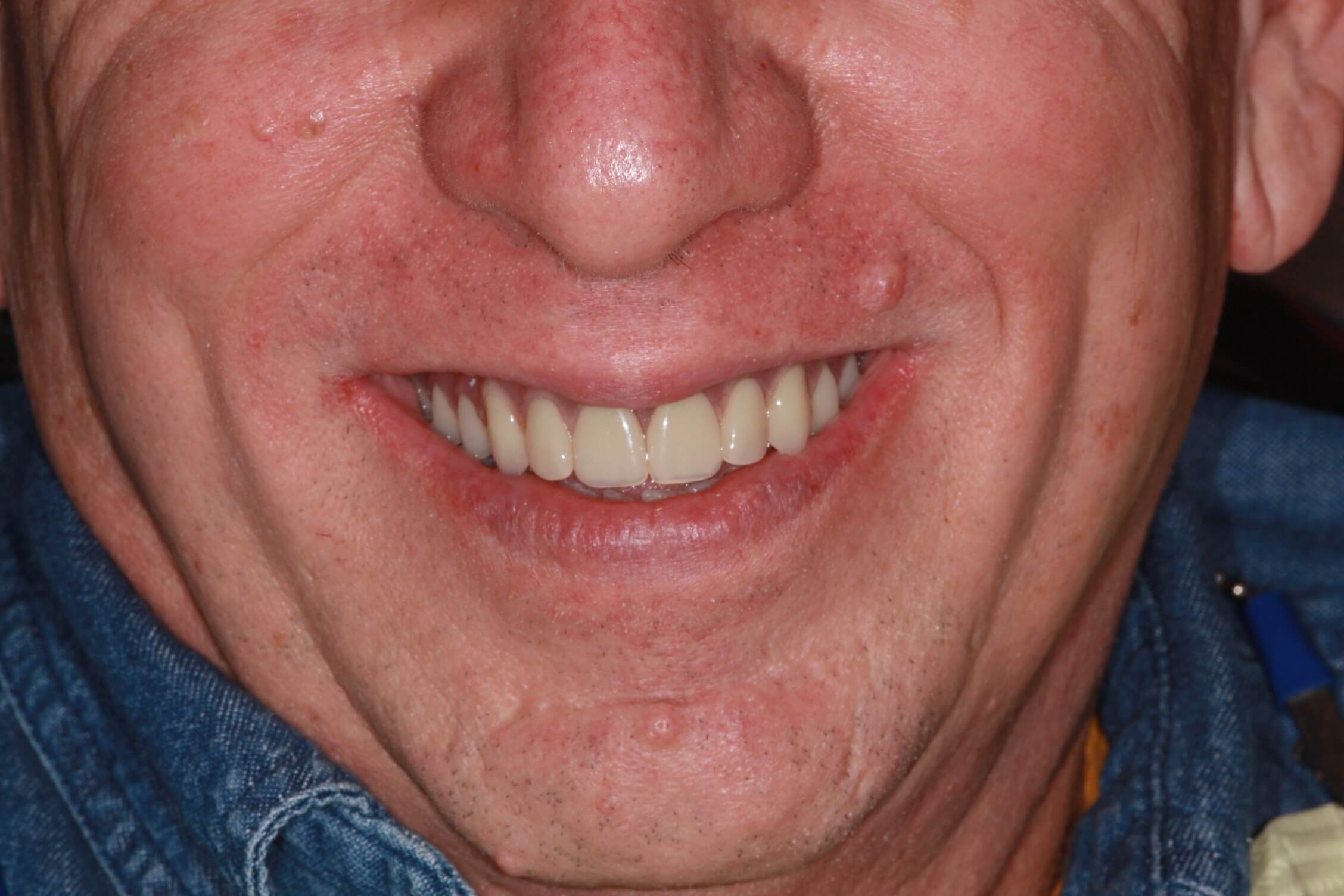 smile makeover after