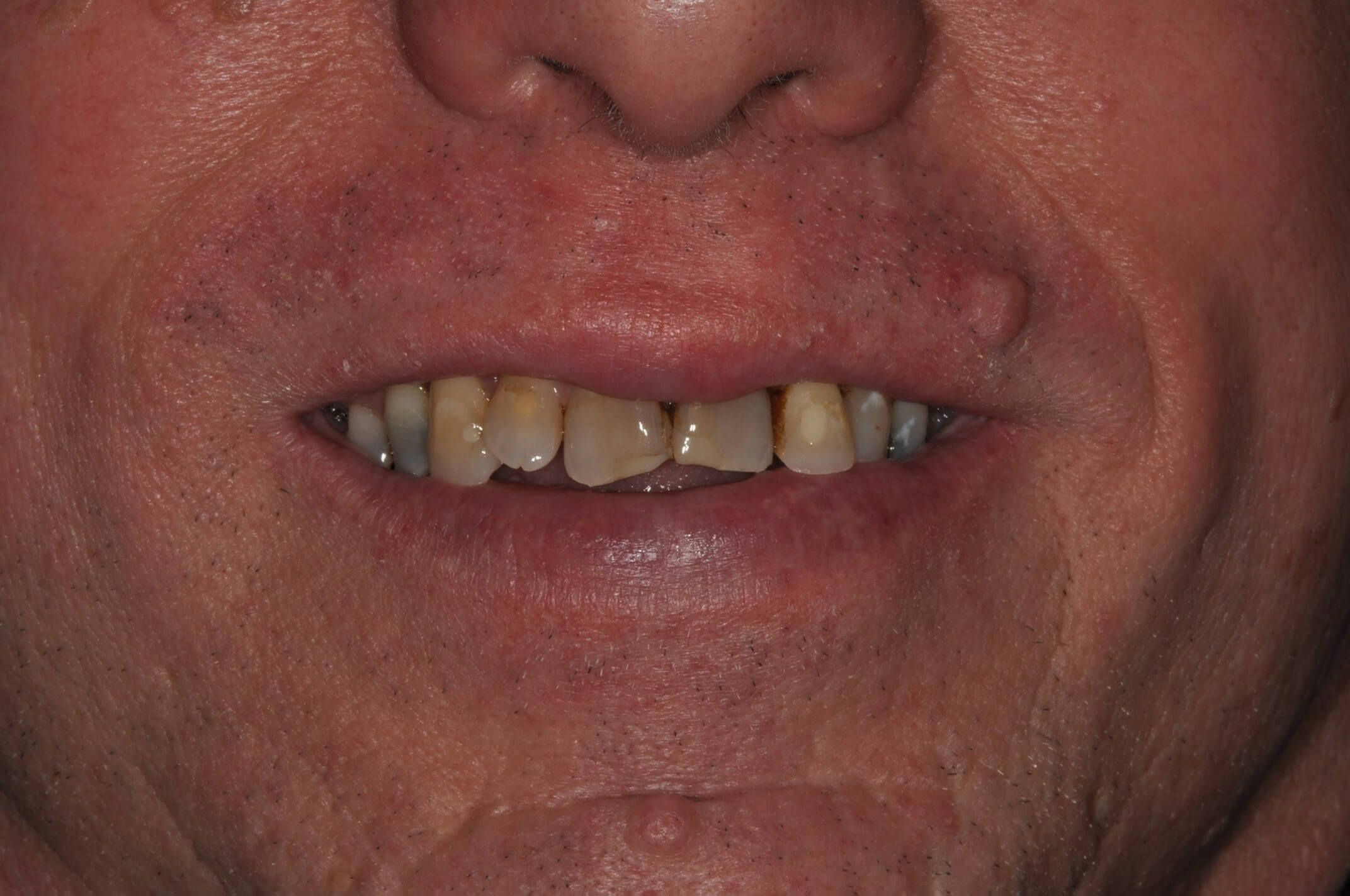 smile makeover before