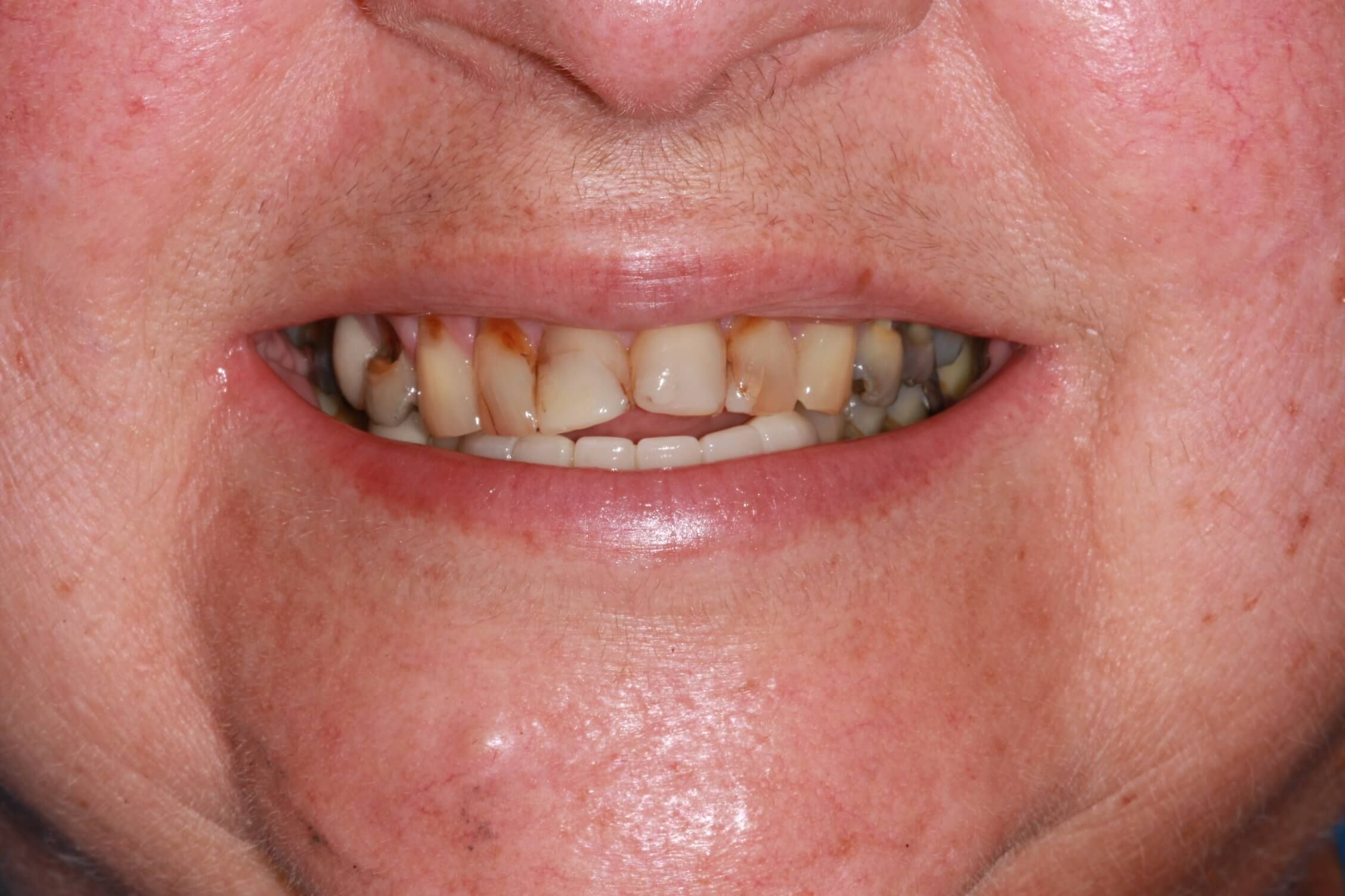 smile makeover before
