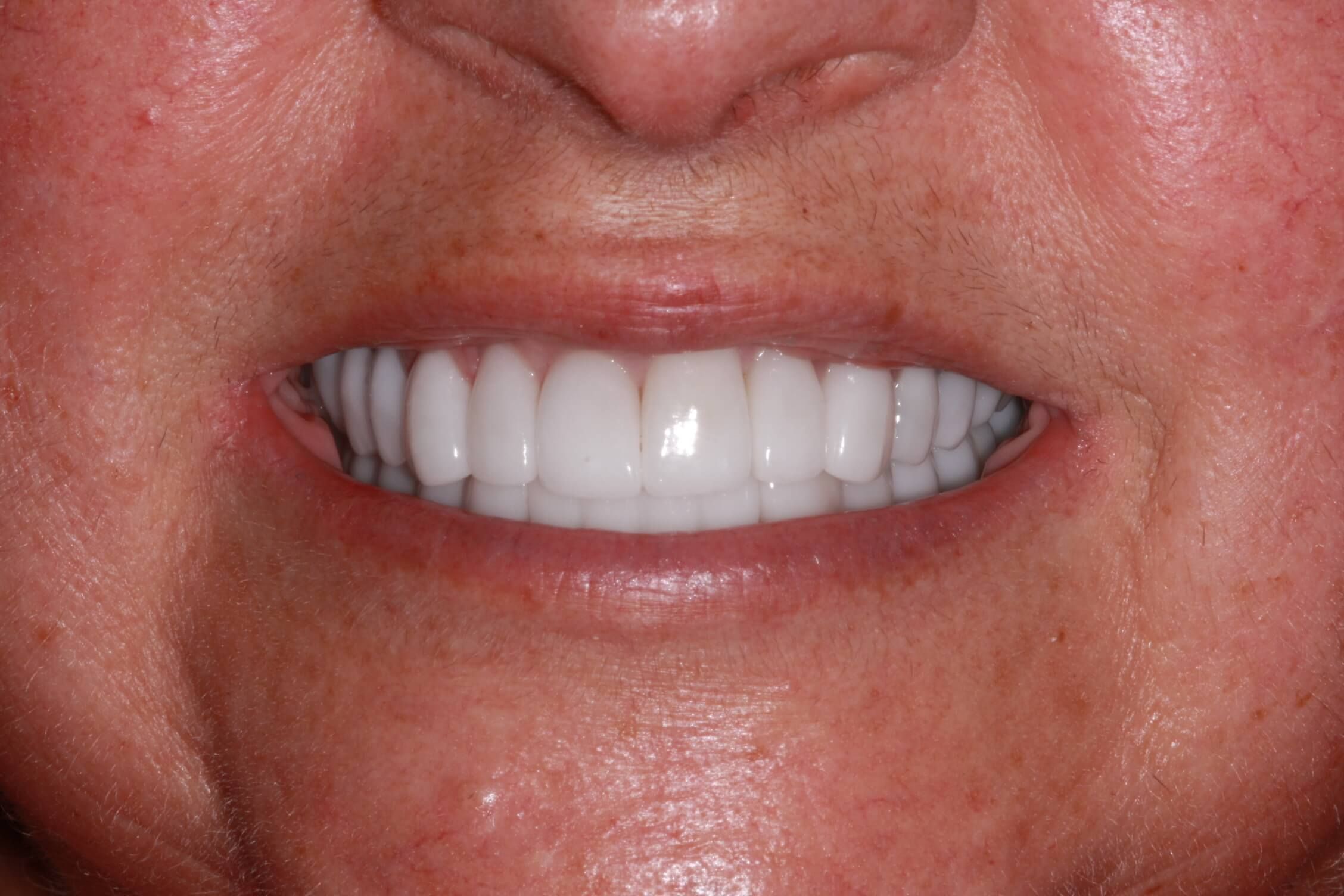 smile makeover after