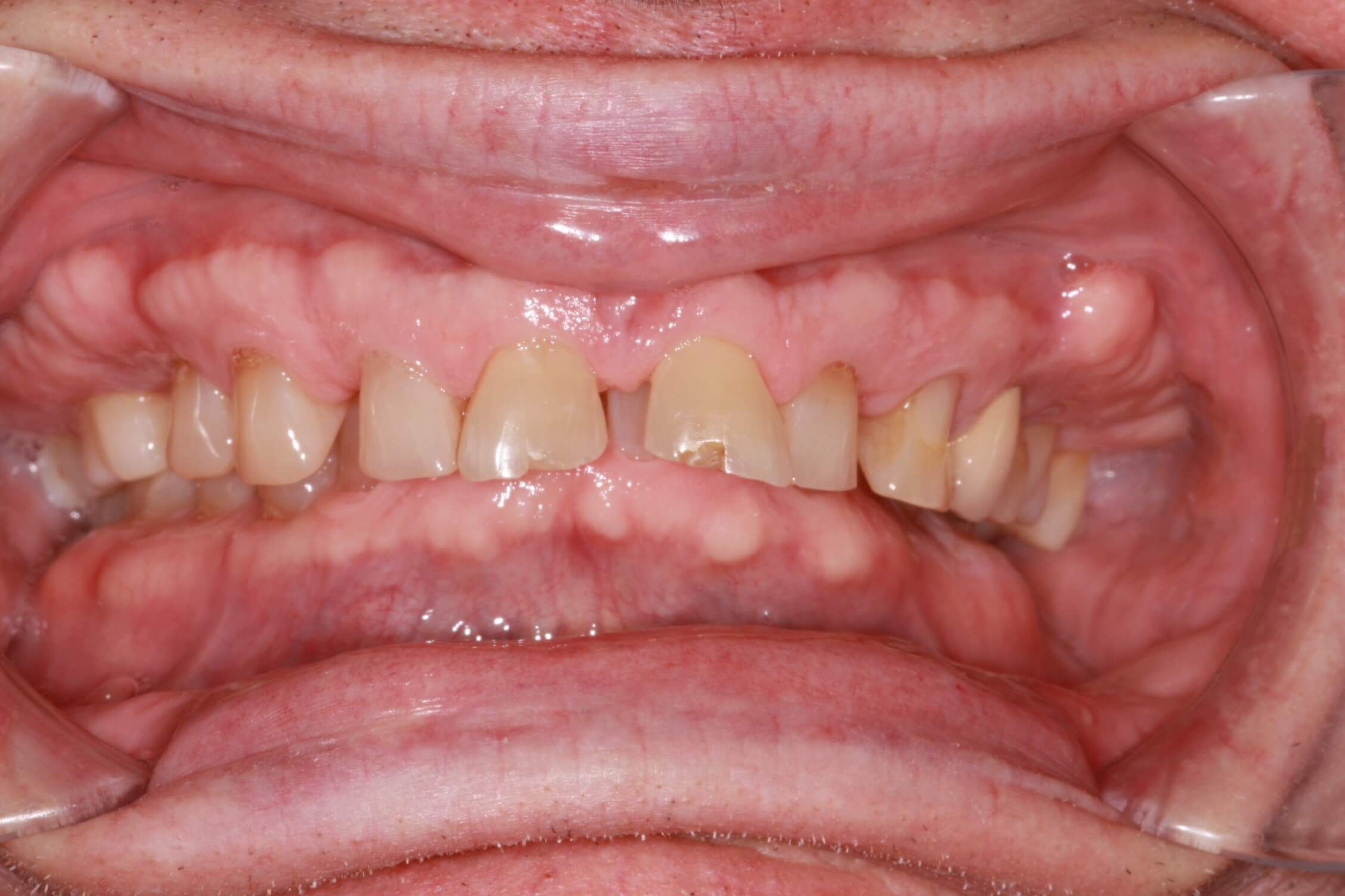 smile makeover before