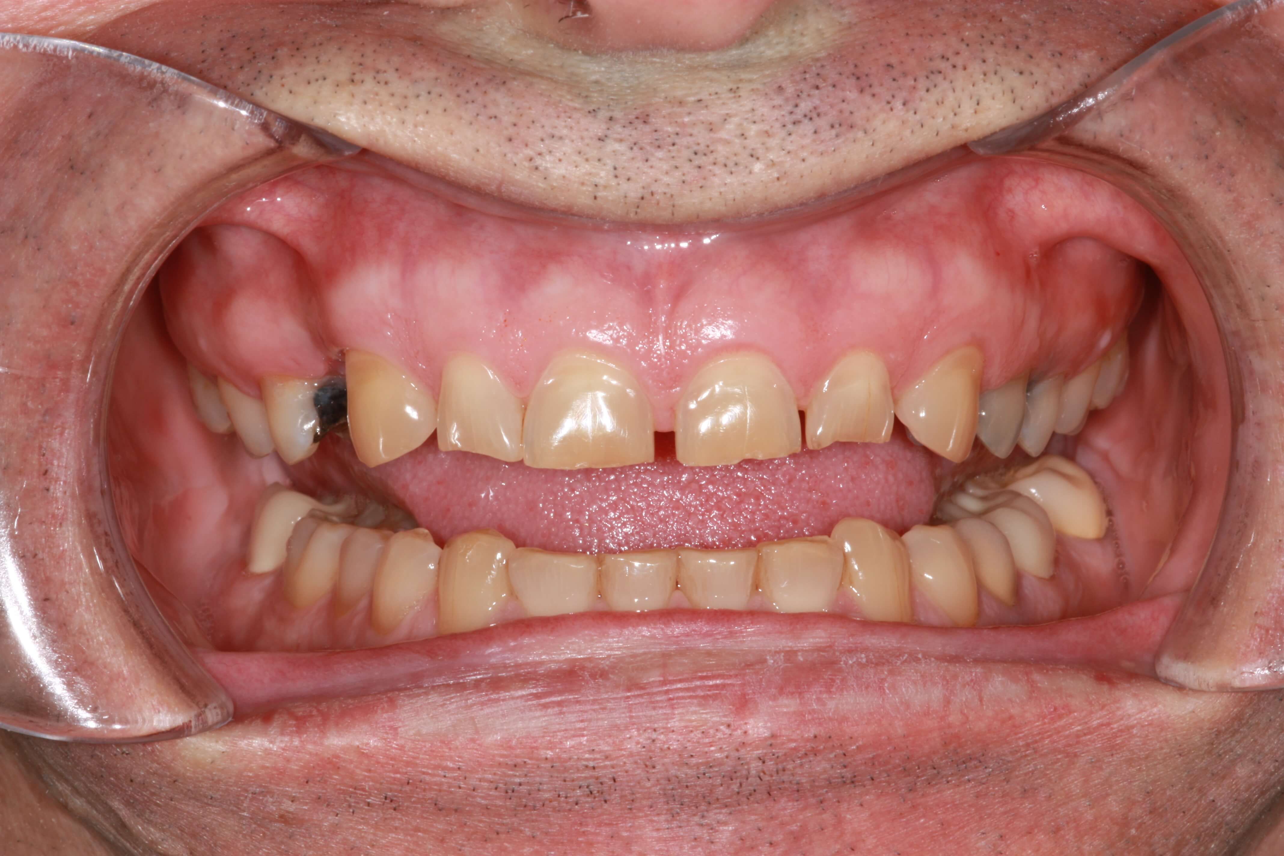smile makeover before