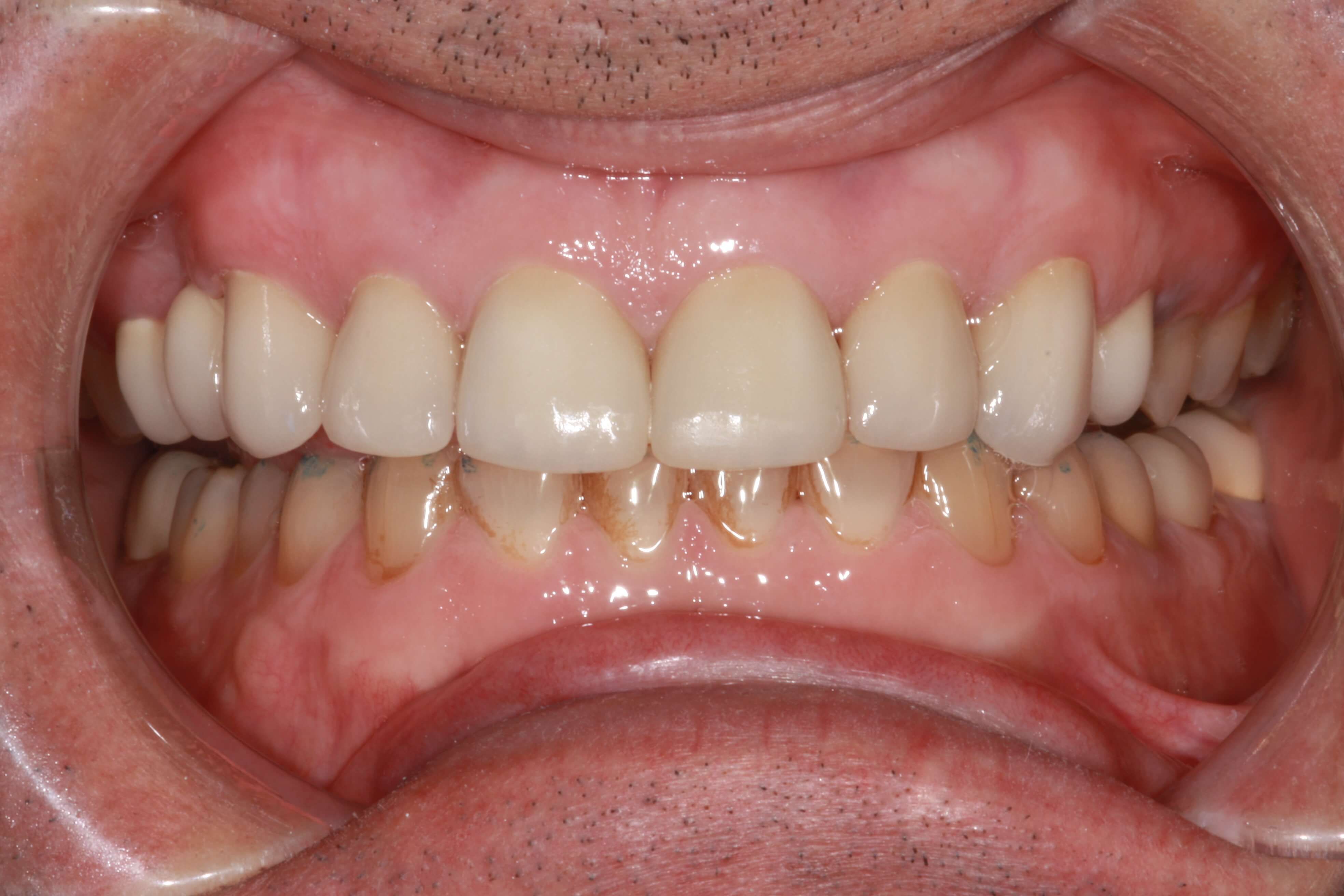 smile makeover after