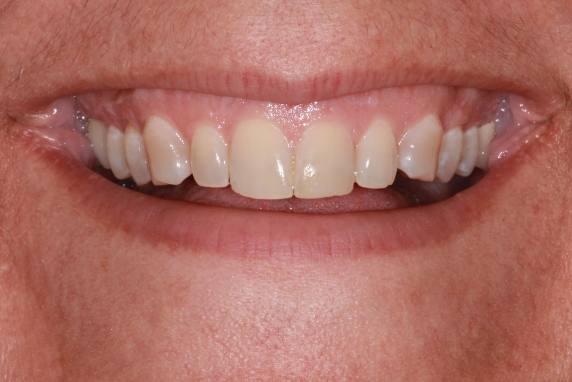 smile makeover after