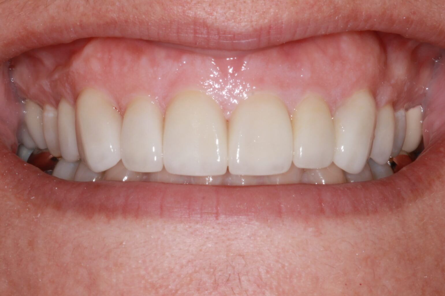 smile makeover after