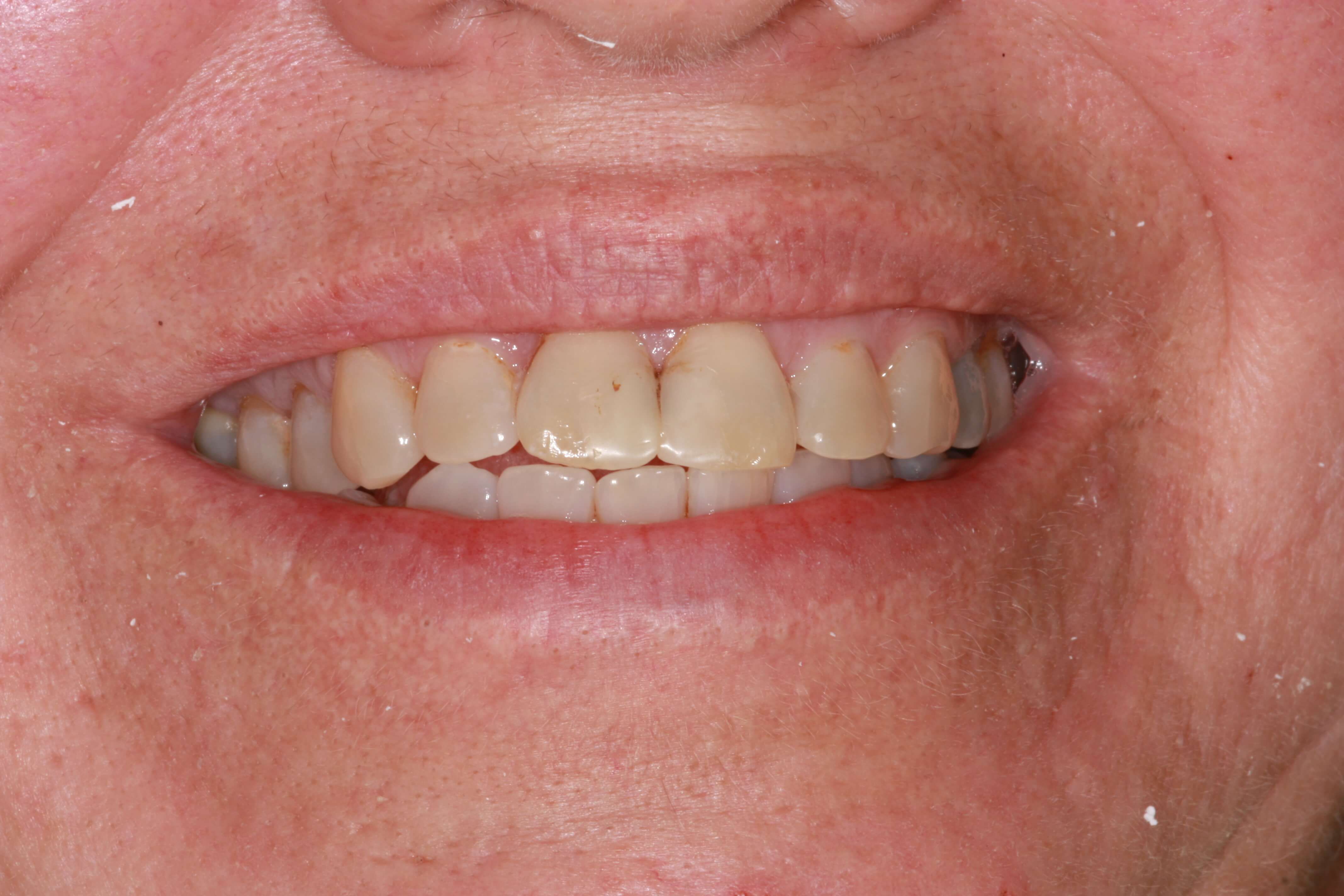 smile makeover before