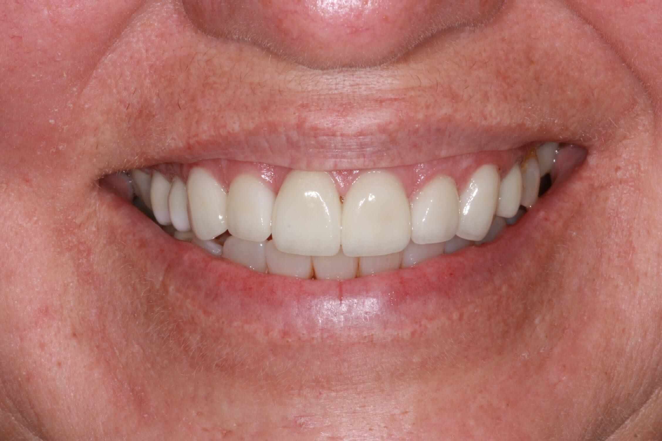 smile makeover after