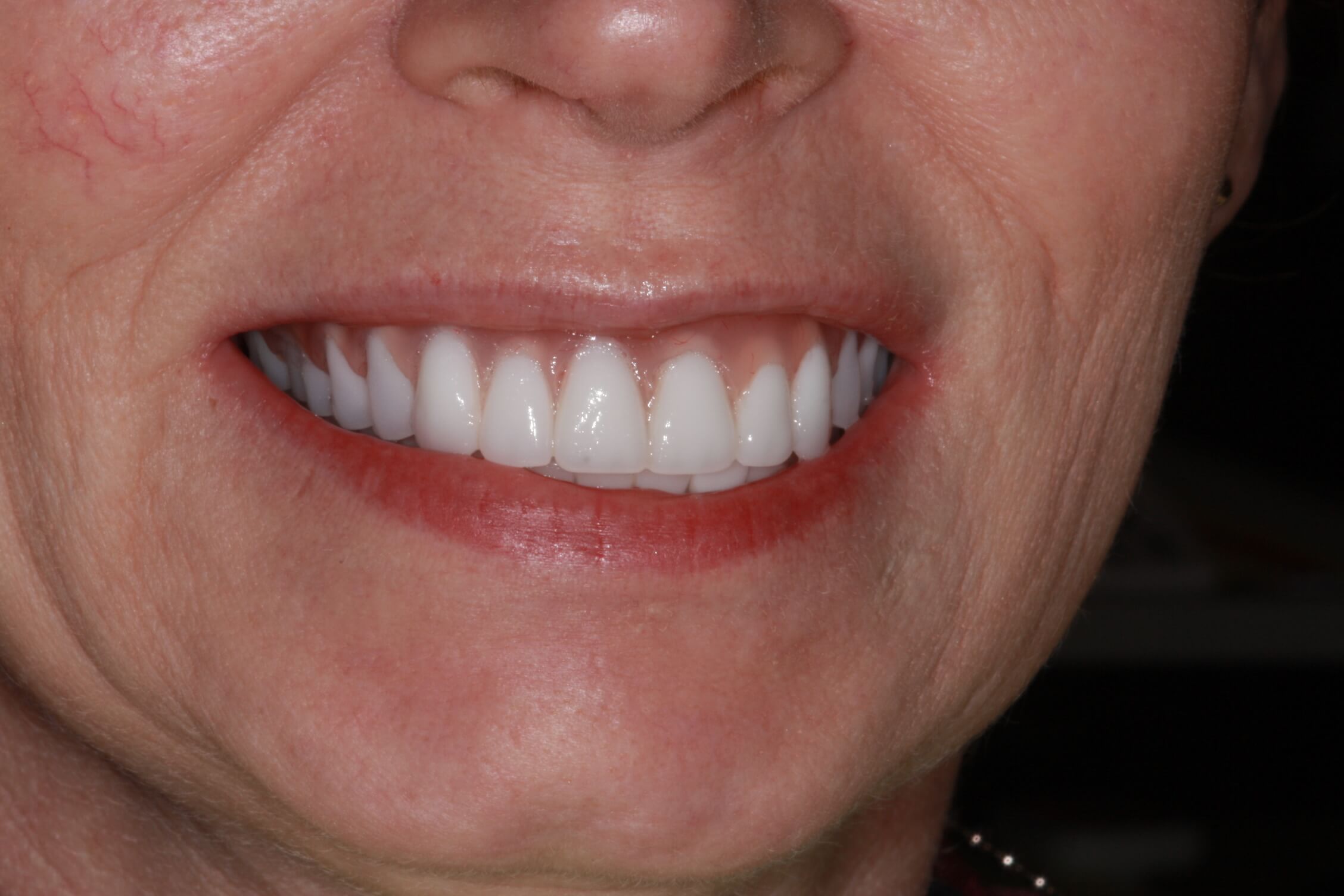 smile makeover after