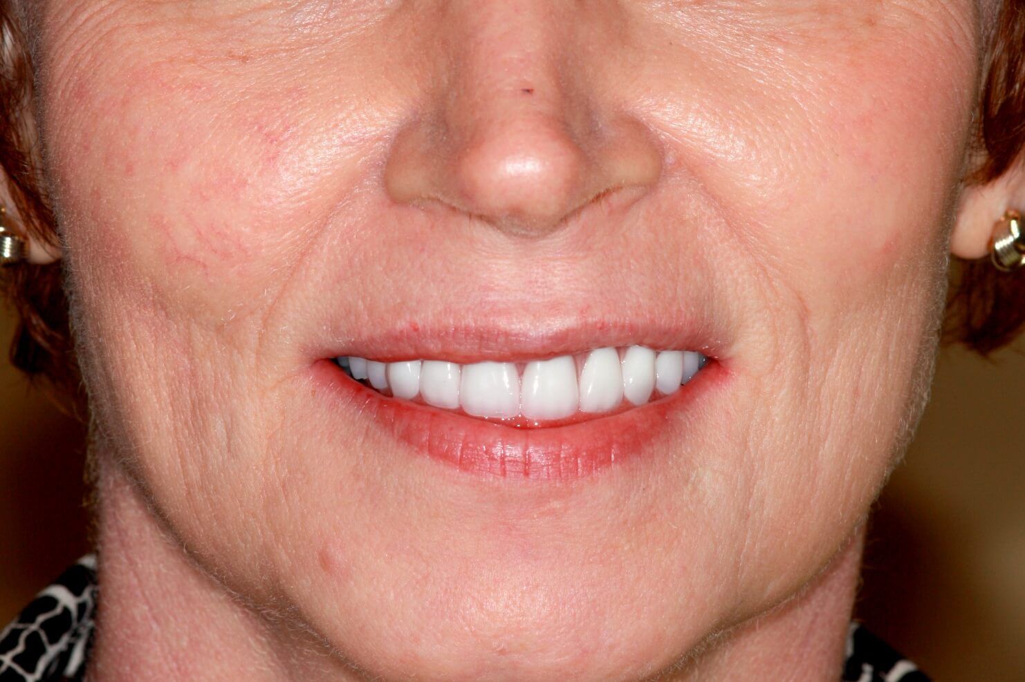 smile makeover after