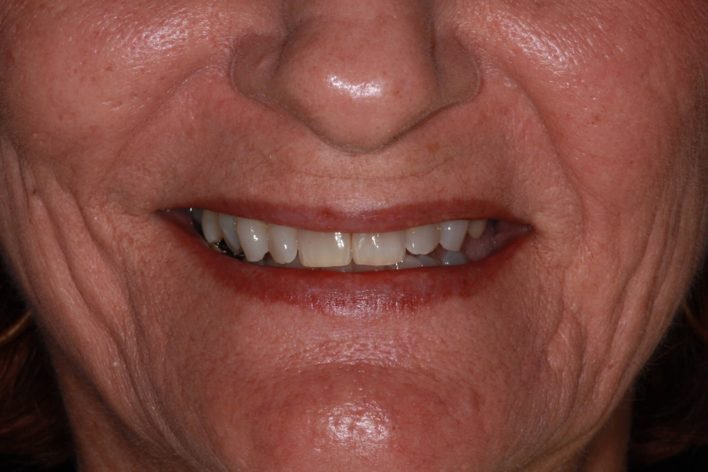 smile makeover after