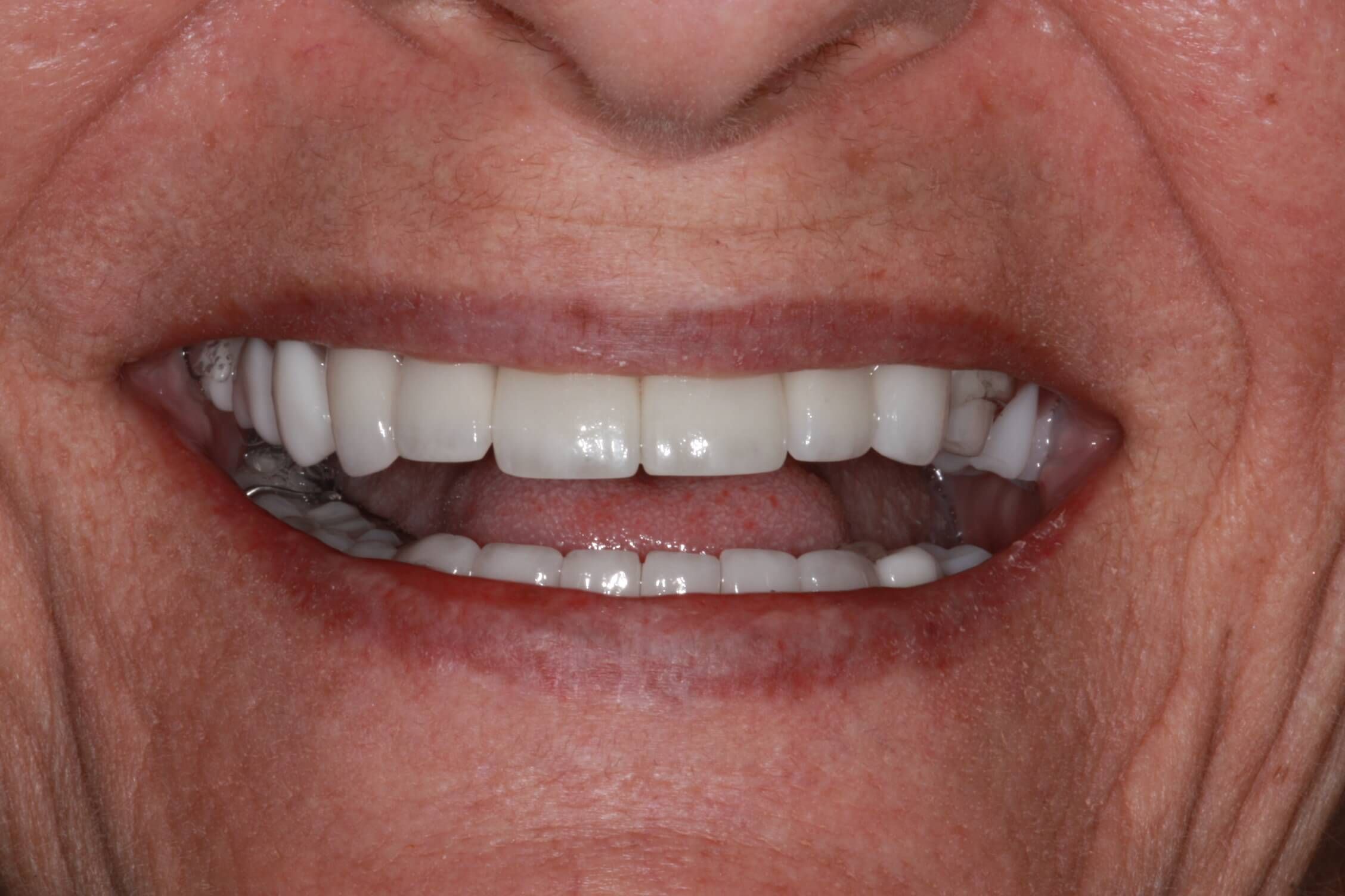 smile makeover after