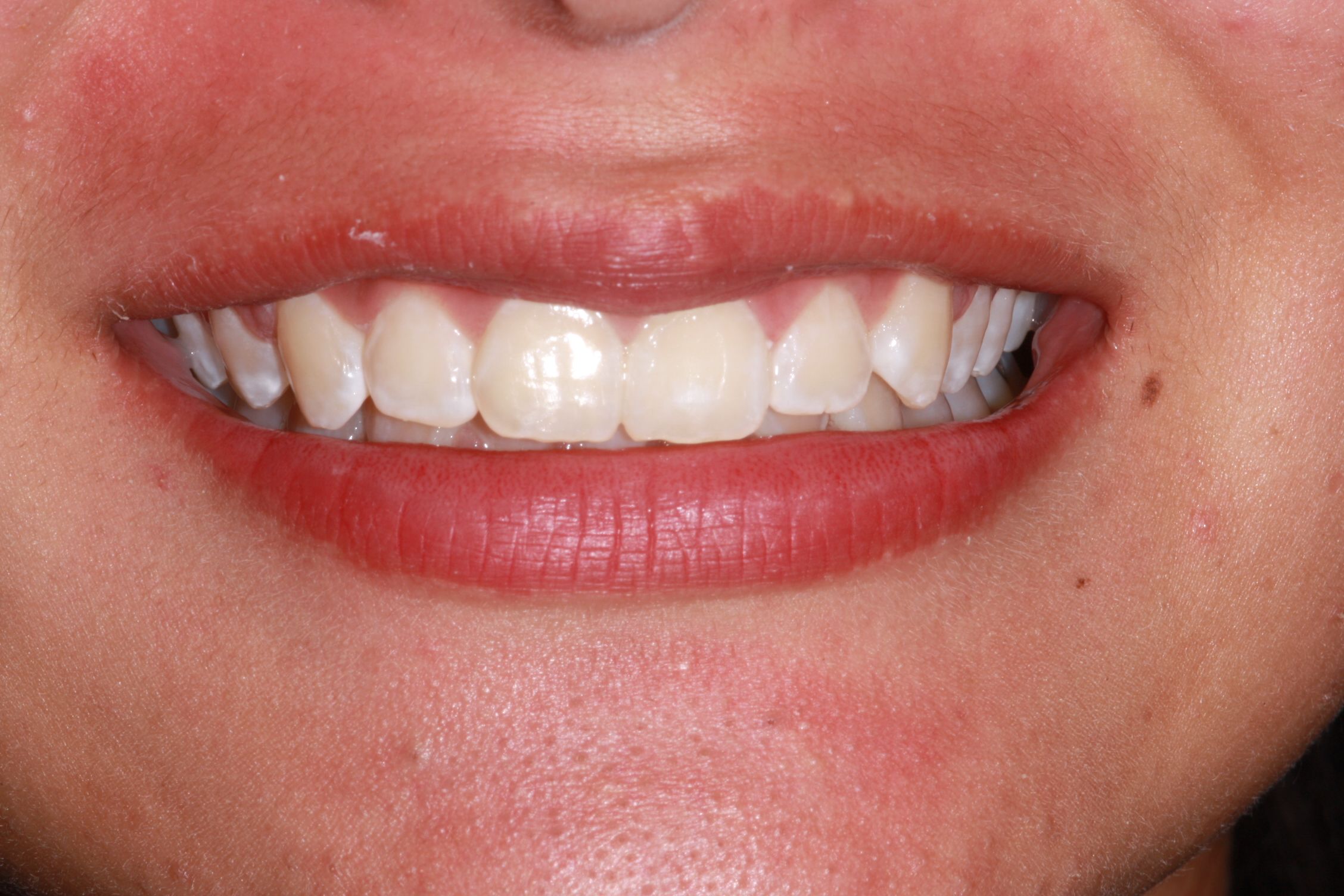 after braces