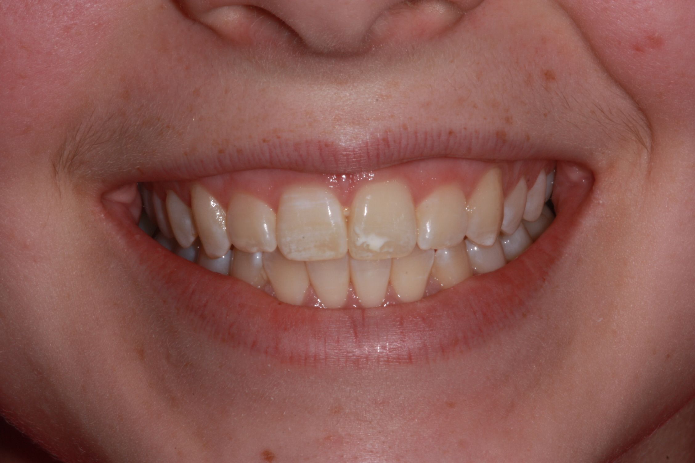 dental decay