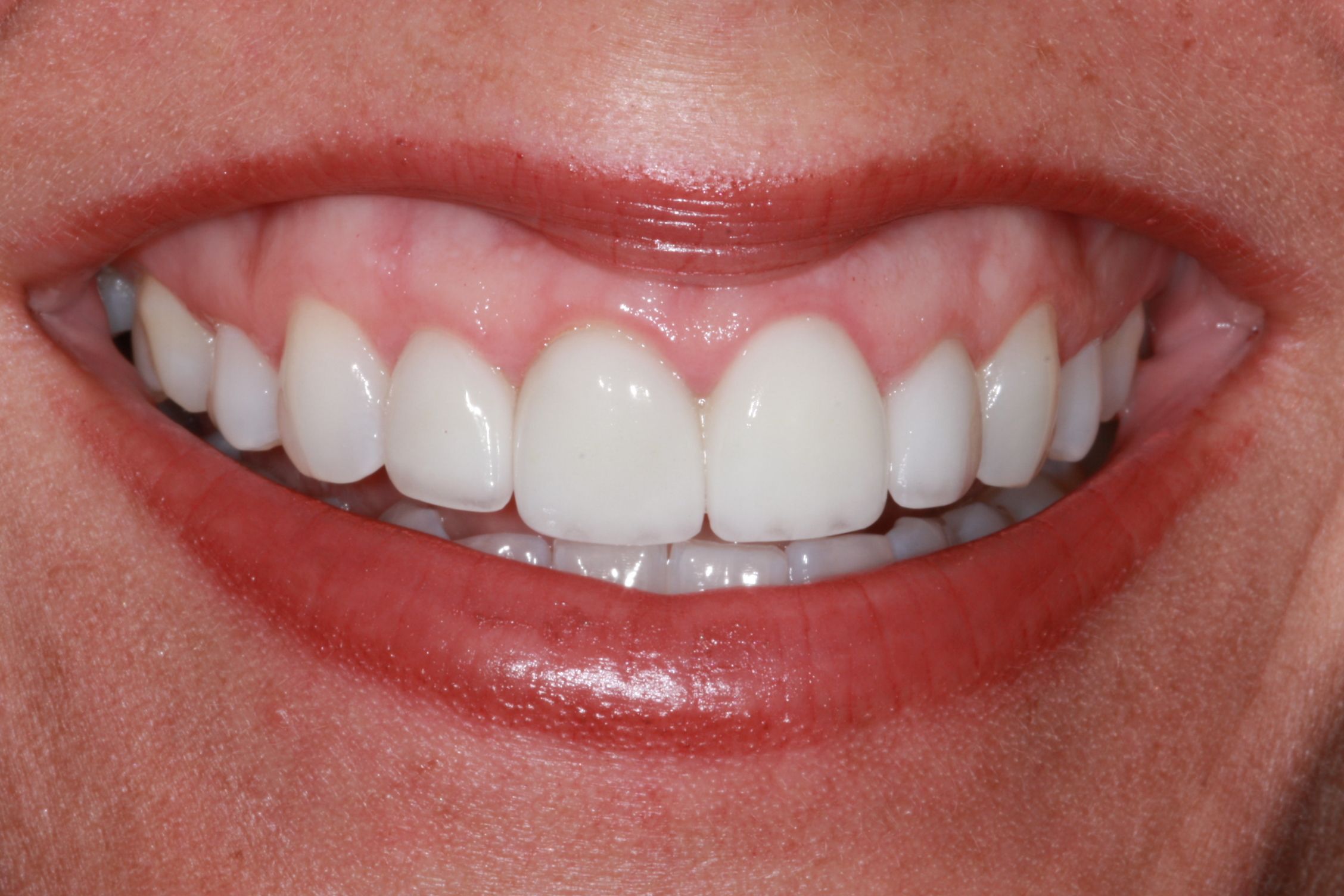 after whitening
