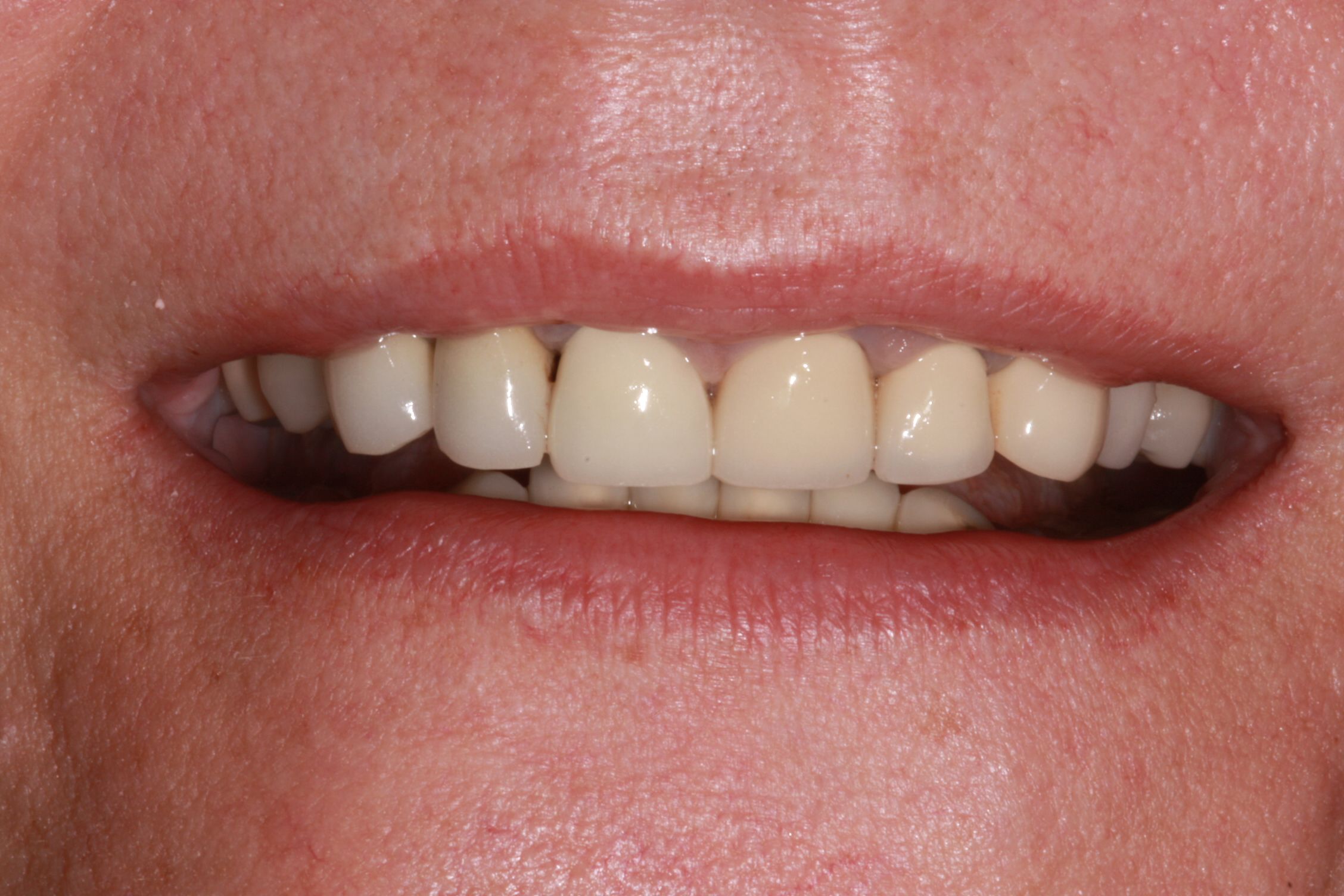 before porcelain veneers