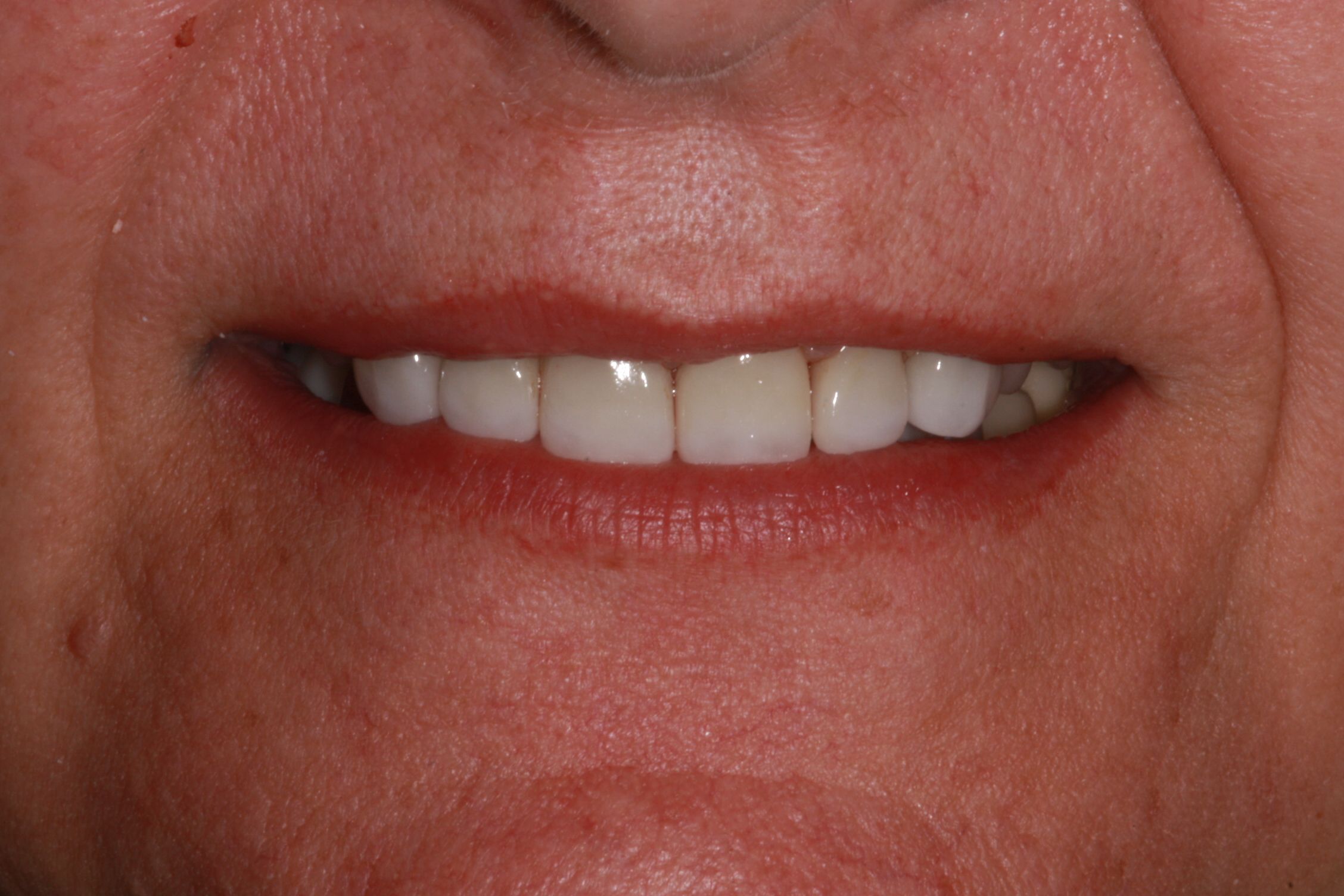 after porcelain veneers