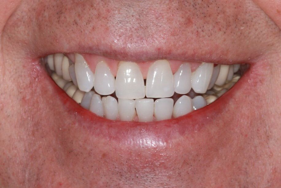 smile touch ups