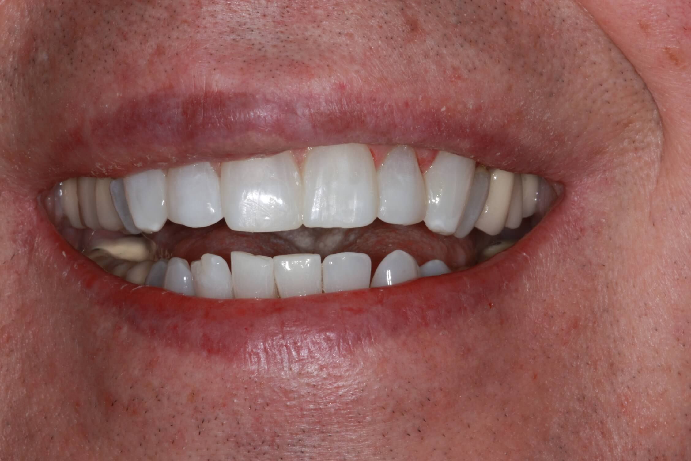 after smile touchup