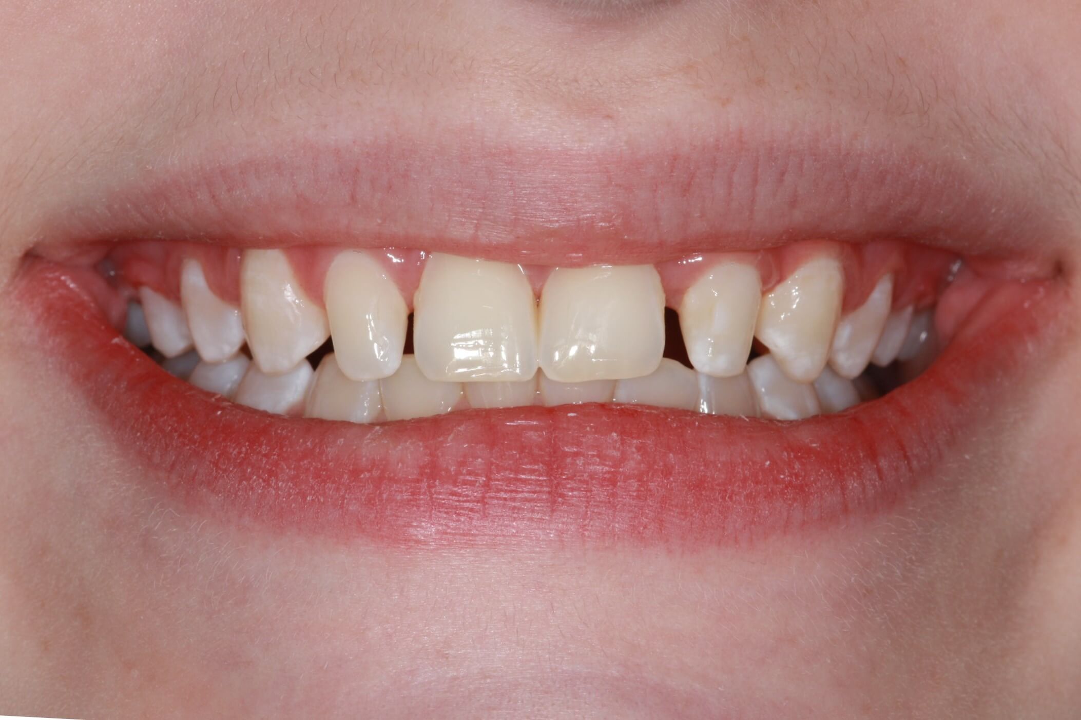 gapped teeth