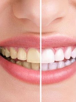 Teeth Whitening in vero beach