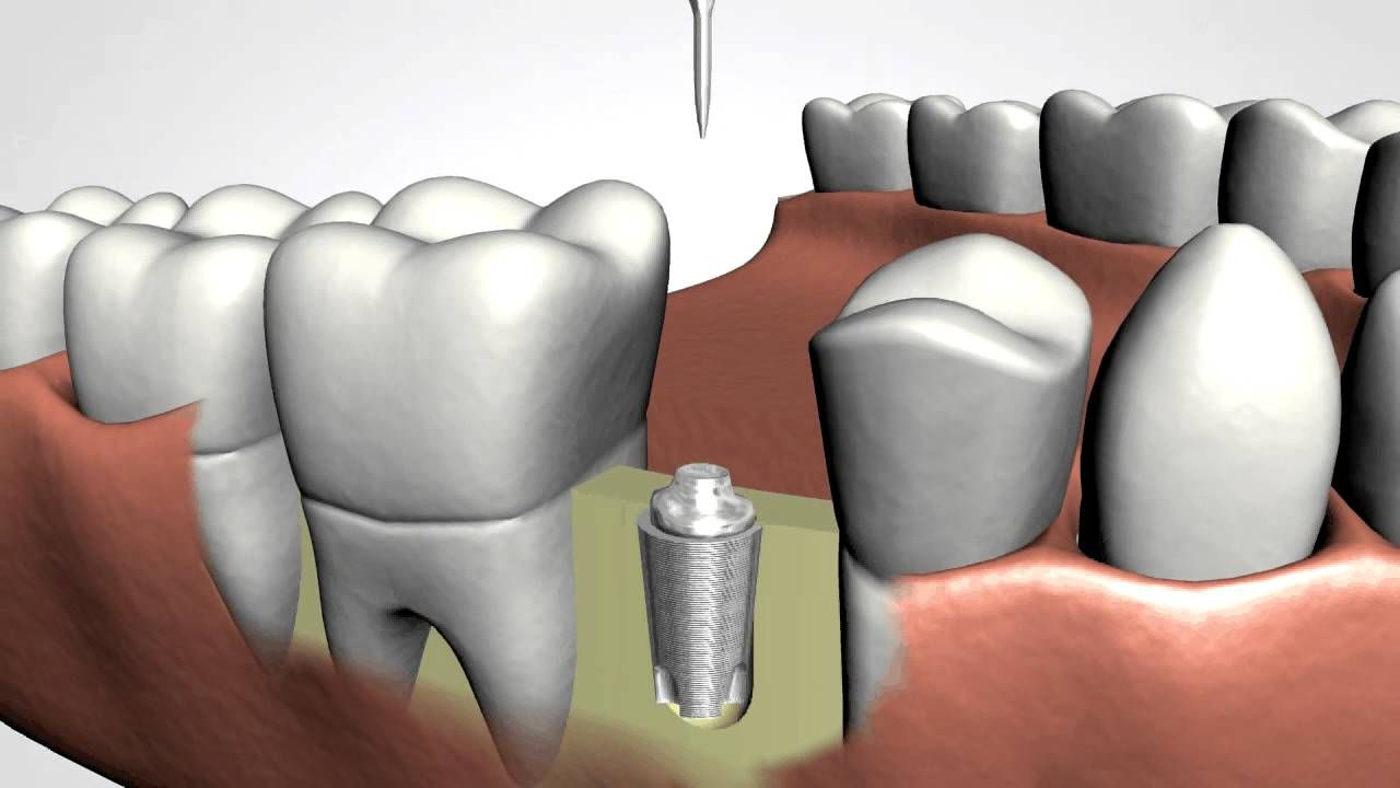 Dental Implants benefits